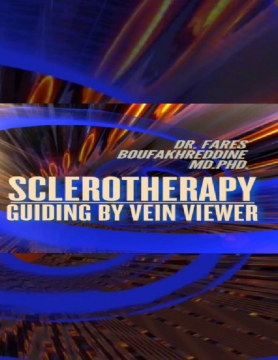 Sclerotherapy and Sclerofoam by dr. Fares Boufakhreddine MD. PhD.