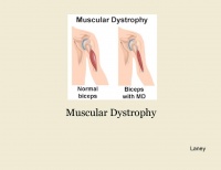 Muscular Dystrophy